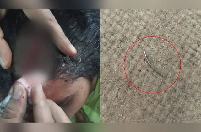 ರೋಗಿಯ ತಲೆಗೆ ಹೊಲಿಗೆ ಹಾಕಿ ಸೂಜಿಯನ್ನು ಅಲ್ಲಿಯೇ ಮರೆತು ಬಿಟ್ಟ ವೈದ್ಯ!