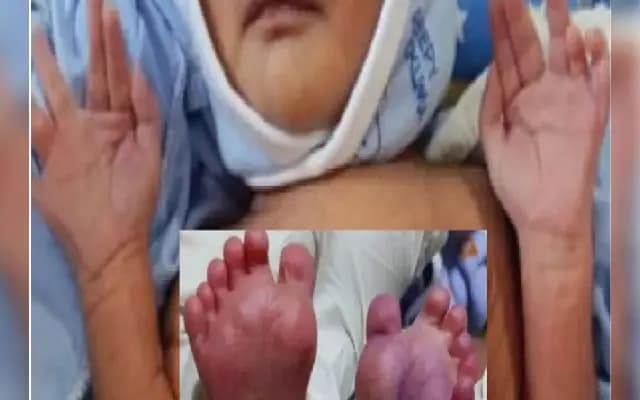 ಅಪರೂಪದಲ್ಲಿ ಅಪರೂಪ ಘಟನೆ : 25 ಬೆರಳುಗಳಿರೋ ಮಗು ಜನನ!