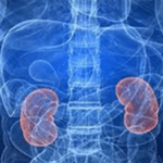 Beware kidney stone can lead to cancer