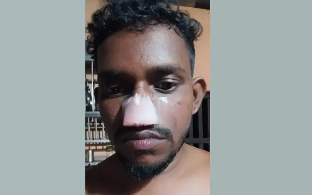 Man bites nose over petty issue